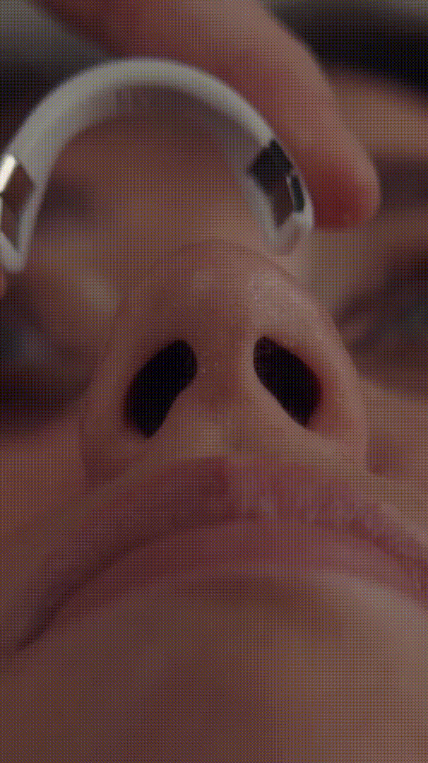 Alpha Kit Dilatador Nasal Magnetico Premium + 120 Parches Magneticos